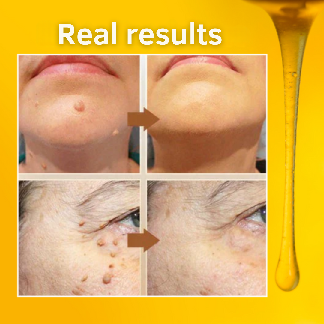 PureSkin™ élimine les verrues et les grains de beauté avec du venin d'abeille. | Garanti une peau lisse et parfaite
