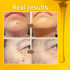 PureSkin™ élimine les verrues et les grains de beauté avec du venin d'abeille. | Garanti une peau lisse et parfaite