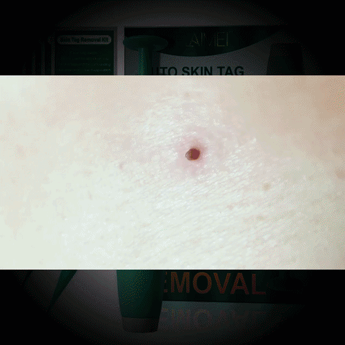 Soft Skin Tag Remover Pen