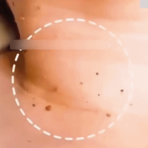 جل إزالة الشامات بلطف