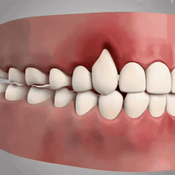 Gum Plus™  Herstelt terugtrekkend tandvlees in 93% van de gevallen in slechts 4 dagen!