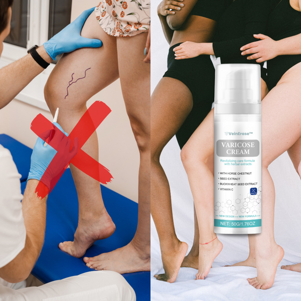 VeinErase™  Elimineert 93% van de spataderen in slechts 7 dagen!